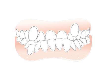 牙齿畸形有哪些危害？